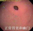 溃疡 溃疡