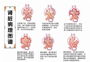 狼疮肾 狼疮肾
