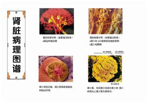狼疮肾 狼疮肾