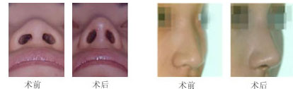 隆鼻 隆鼻
