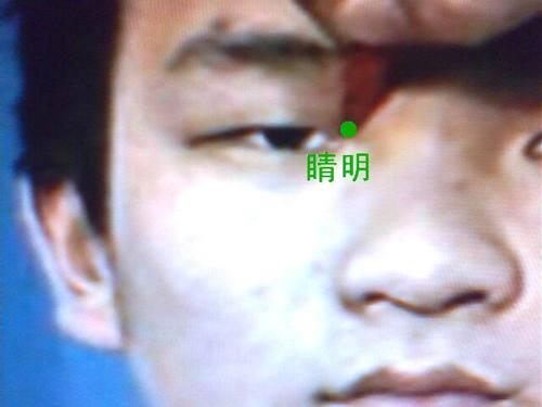 睛明穴 睛明穴