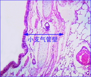 急性肺栓塞 急性肺栓塞