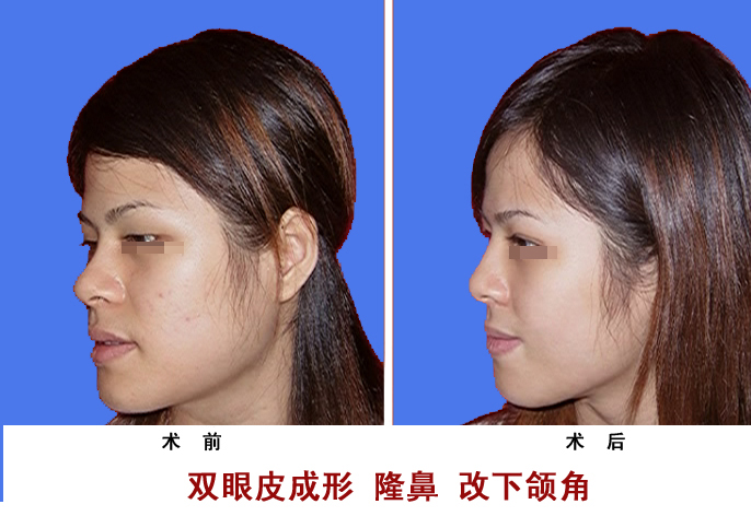隆鼻 隆鼻