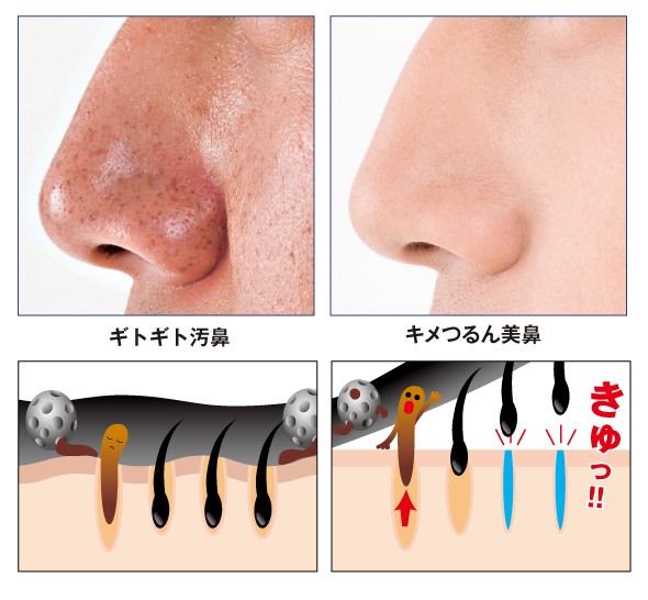 角栓 角栓