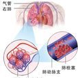 肺血栓栓塞症 肺血栓栓塞症