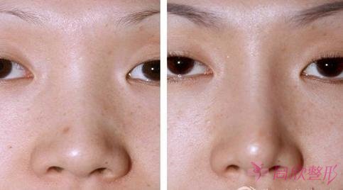 隆鼻效果 隆鼻效果