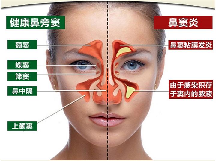 慢性过敏性鼻炎 慢性过敏性鼻炎