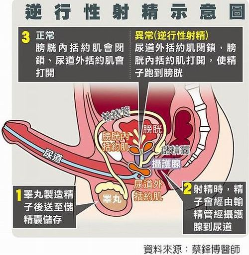 逆向射精 逆向射精