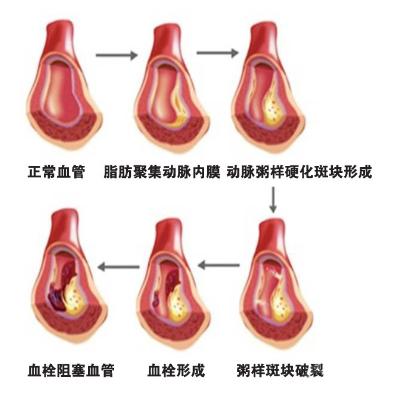 血栓 血栓