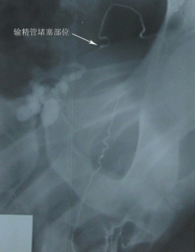 无精子症 无精子症