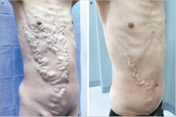 腹水综合徵 腹水综合徵