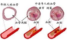 血栓 血栓