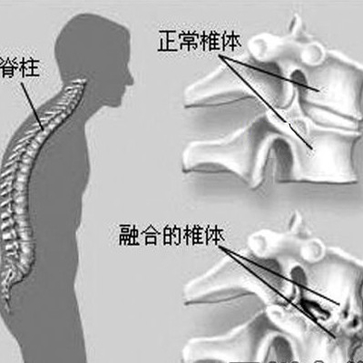 强直性脊柱炎 强直性脊柱炎