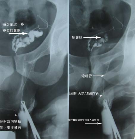 无精子症 无精子症