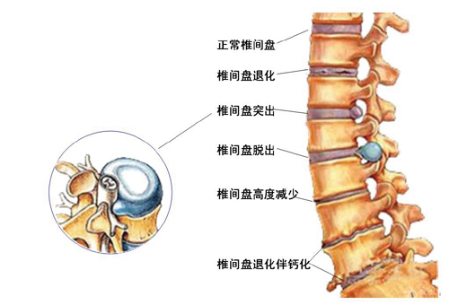 椎间盘变性 椎间盘变性