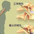 强脊炎 强脊炎