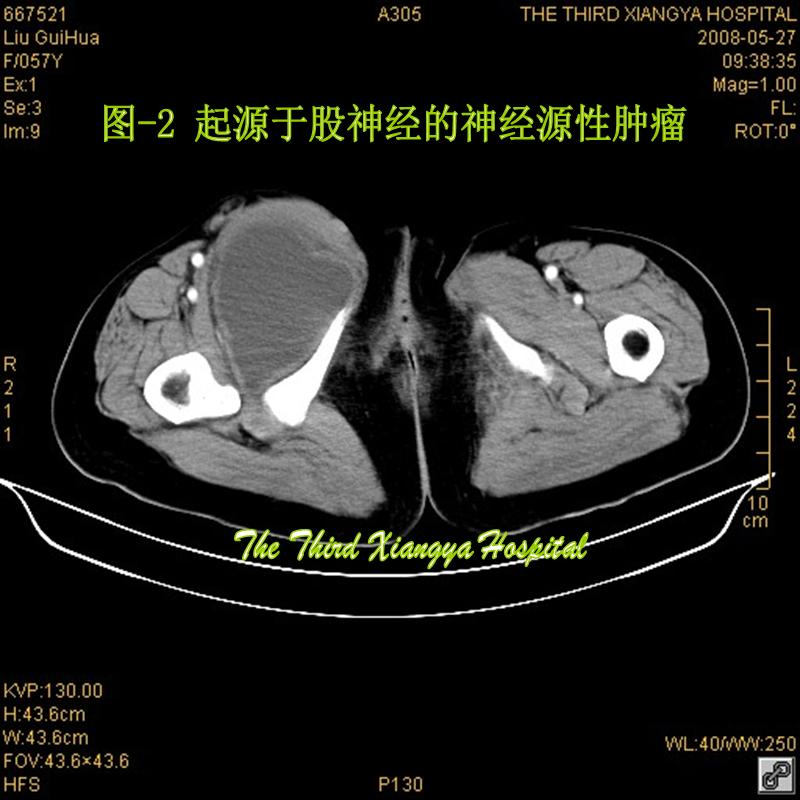 神经源性肿瘤 神经源性肿瘤