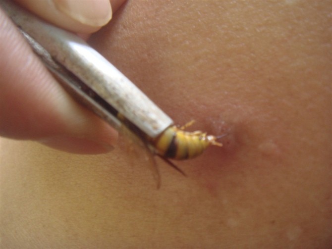 蜂疗 蜂疗