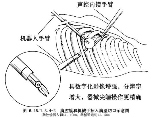 机器人辅助的胸腔镜CABG 机器人辅助的胸腔镜CABG