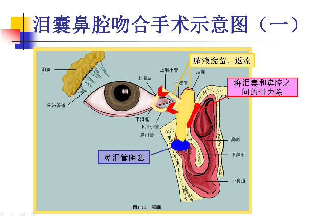 泪囊鼻腔吻合术 泪囊鼻腔吻合术