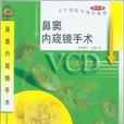 鼻窦内窥镜手术 鼻窦内窥镜手术