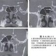 鼻内镜下视神经管减压术 鼻内镜下视神经管减压术