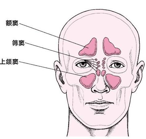 慢性副鼻窦炎 慢性副鼻窦炎