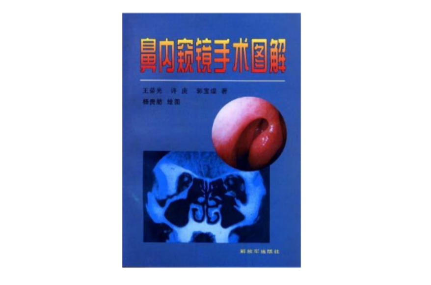 鼻内窥镜手术图解 鼻内窥镜手术图解