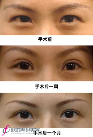 切开双眼皮手术案例对比图 切开双眼皮手术案例对比图