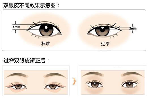 双眼皮修复手术 双眼皮修复手术