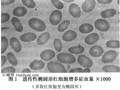 遗传性椭圆形红细胞增多症 遗传性椭圆形红细胞增多症