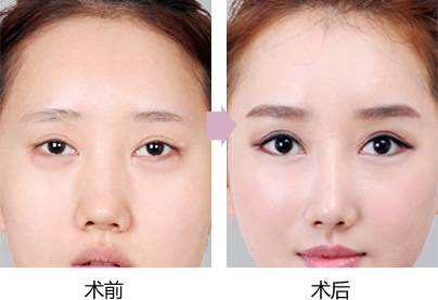 双眼皮修复术 双眼皮修复术