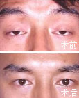 上眼睑下垂矫正 上眼睑下垂矫正