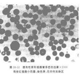 遗传性椭圆形红细胞增多症 遗传性椭圆形红细胞增多症