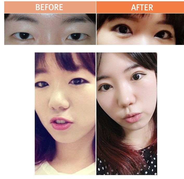 眼部抽脂 眼部抽脂