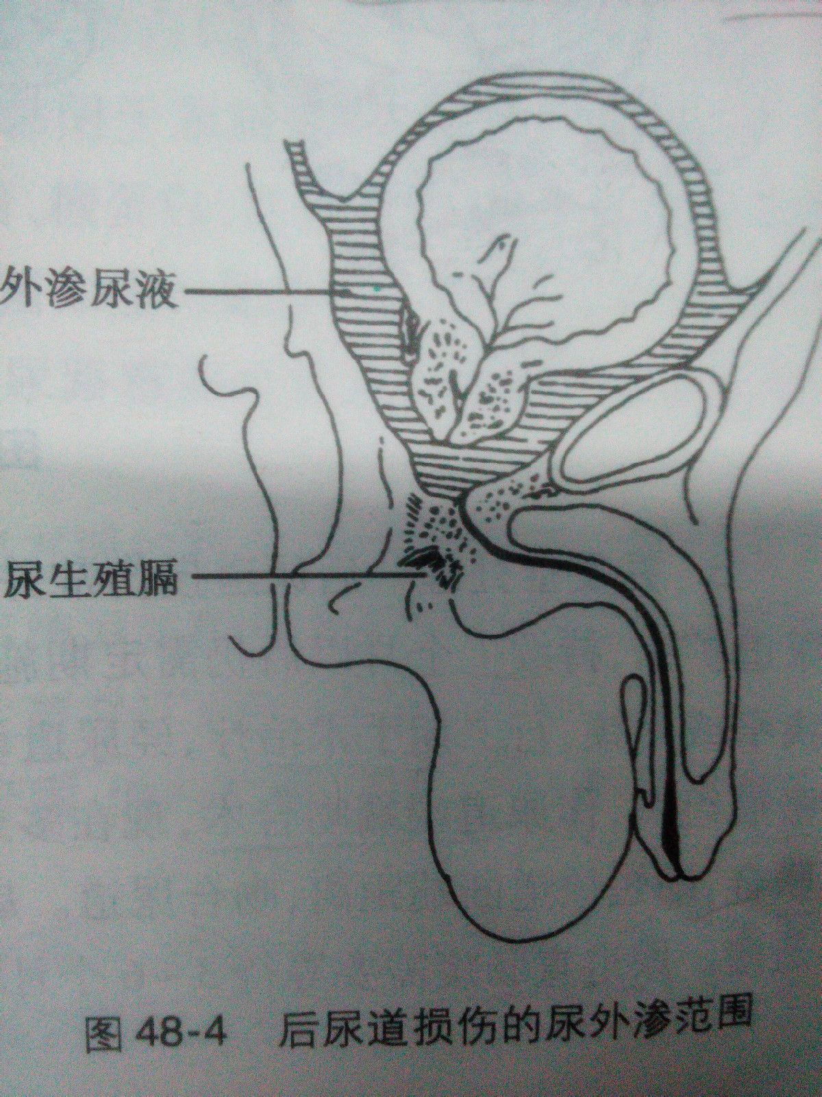 后尿道断裂 后尿道断裂