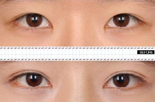 双眼皮埋线 双眼皮埋线