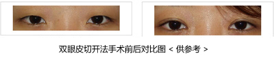 双眼皮切开法手术前后对比 双眼皮切开法手术前后对比