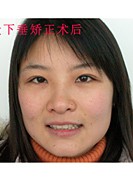上眼睑下垂 上眼睑下垂