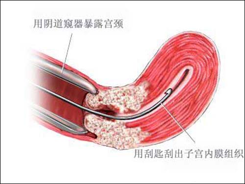 子宫纤维瘤 子宫纤维瘤