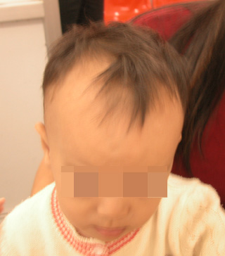 婴幼儿维生素D缺乏性佝偻病 婴幼儿维生素D缺乏性佝偻病