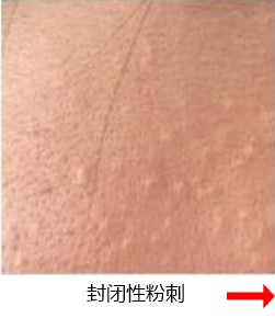 封闭性粉刺 封闭性粉刺