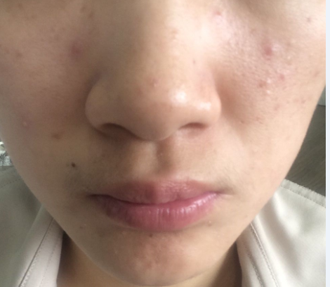 闭合性粉刺 闭合性粉刺