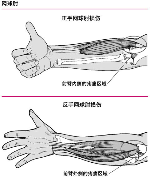 网球肘 网球肘