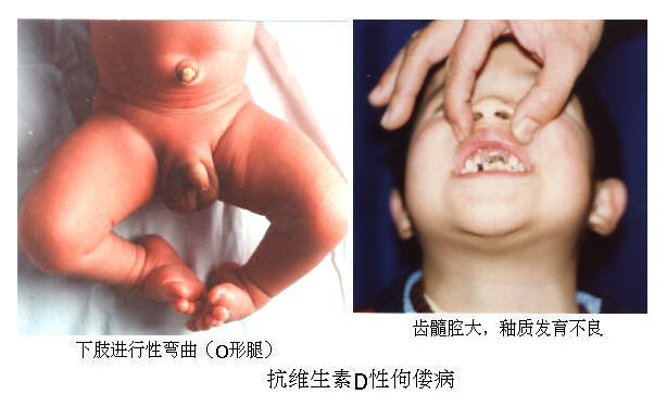 抗维生素D佝偻病 抗维生素D佝偻病