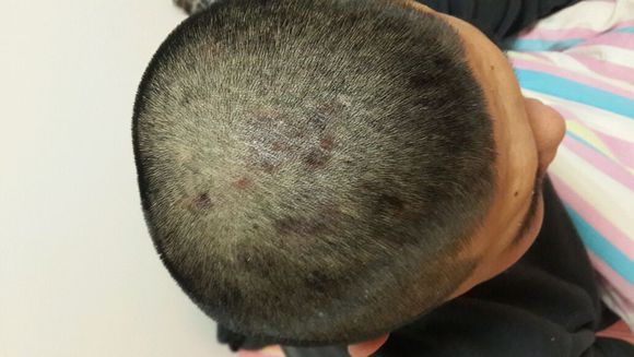 头部脂溢性皮炎 头部脂溢性皮炎