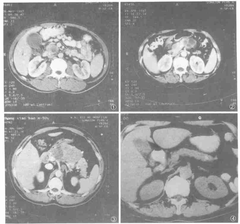 胰腺癌肝转移 胰腺癌肝转移