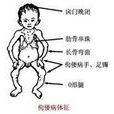 佝偻症 佝偻症
