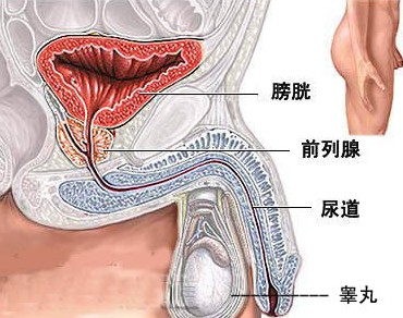 浅表性膀胱癌 浅表性膀胱癌