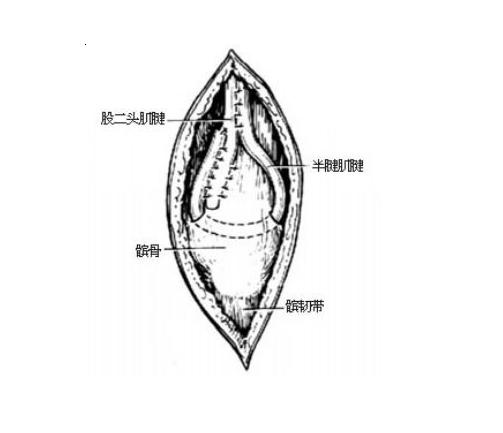 代股四头肌手术 代股四头肌手术